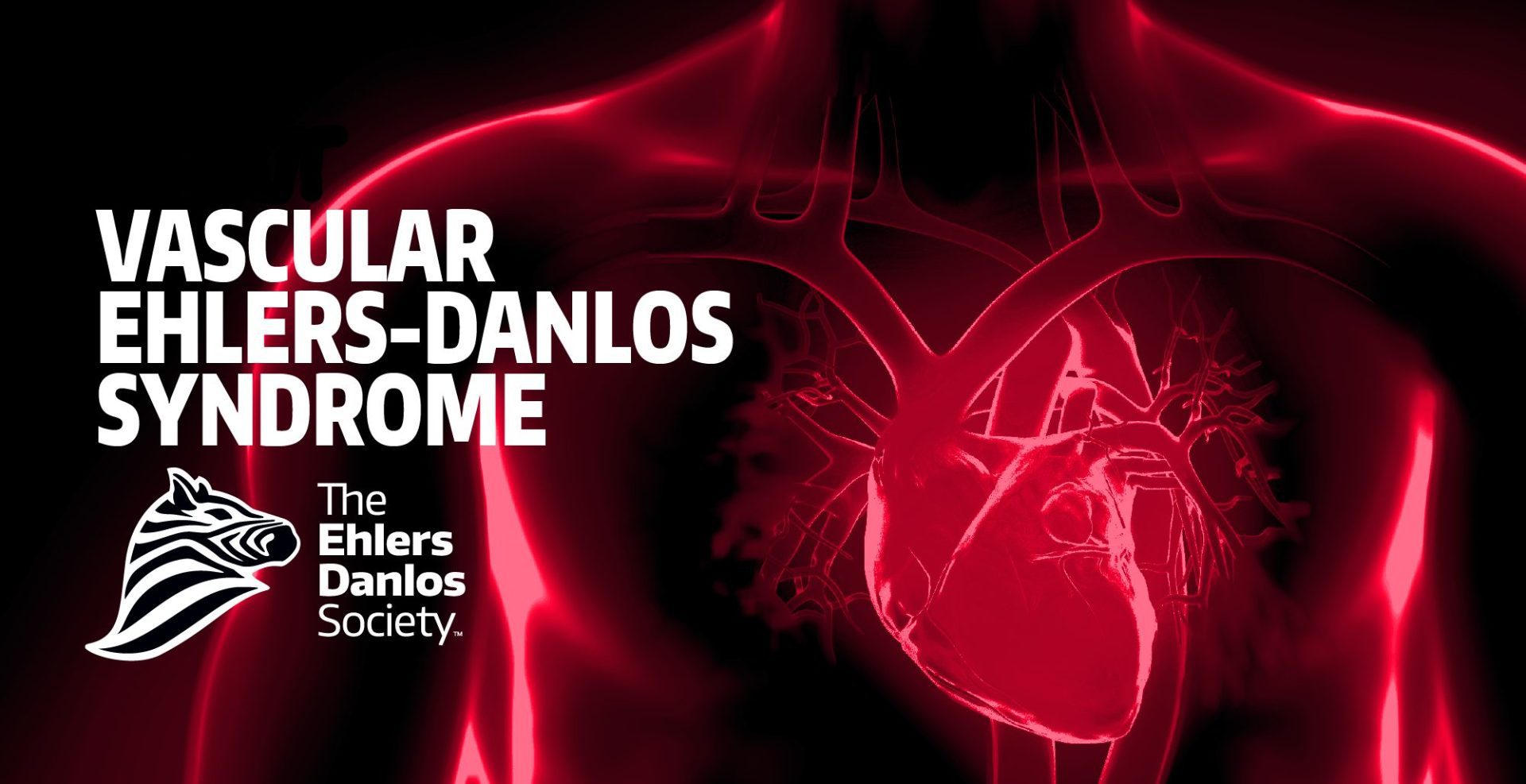 Vascular Ehlers-Danlos Syndrome Vascular Ehlers-Danlos Syndrome