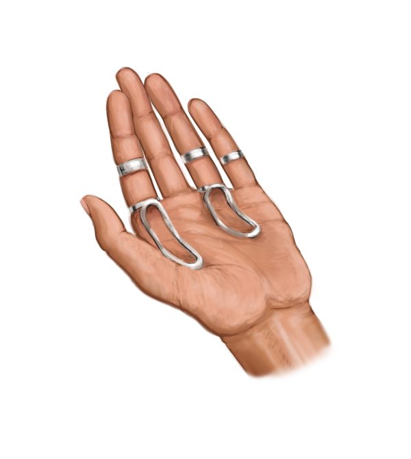 Ring splints for EhlersDanlos syndrome & hypermobility spectrum