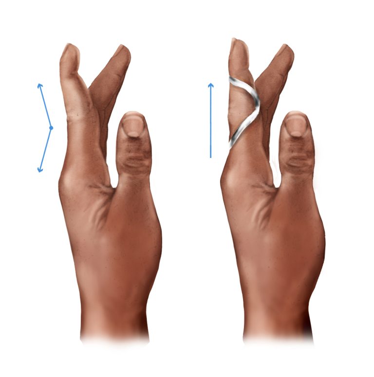 Ring splints for EhlersDanlos syndrome & hypermobility spectrum