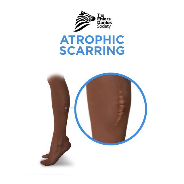 illustration_atrophic_scarring_labelled